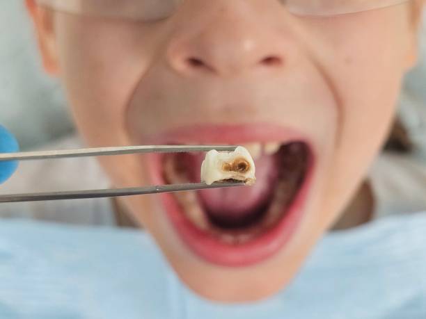 Best Cracked Tooth Emergency Dentist  in Big Sky, MT